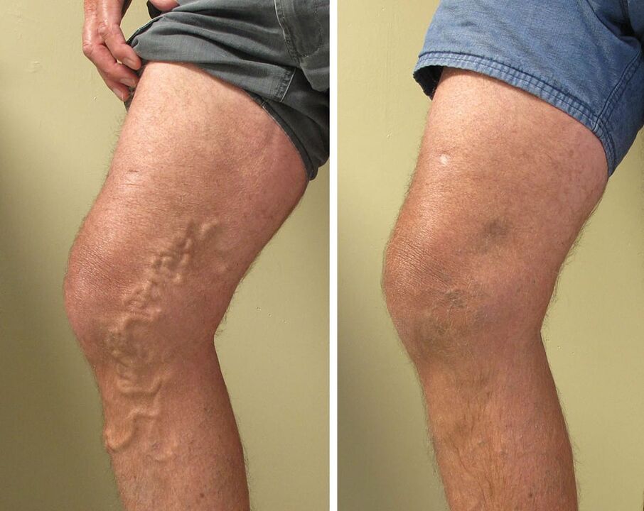 Experience of using Gel Vasaxal