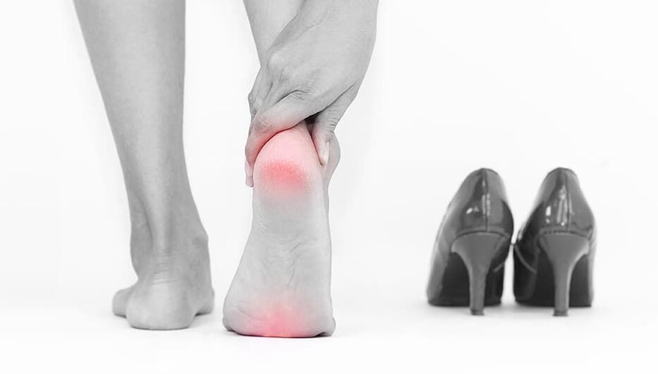 The reason for the appearance of varicose veins is unpleasant shoes