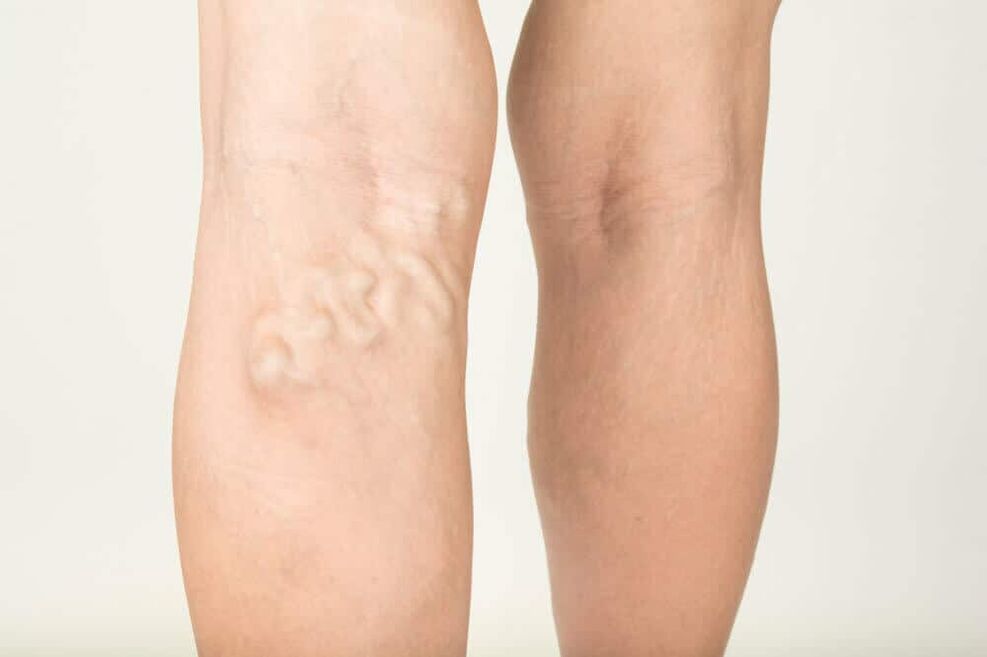 Varicose vein event