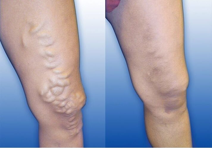 Causes of varicose veins