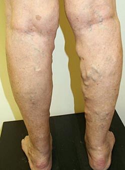 Varicose veins on their feet