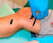 Leens for varicose veins