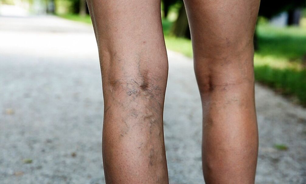 Extended veins on their feet