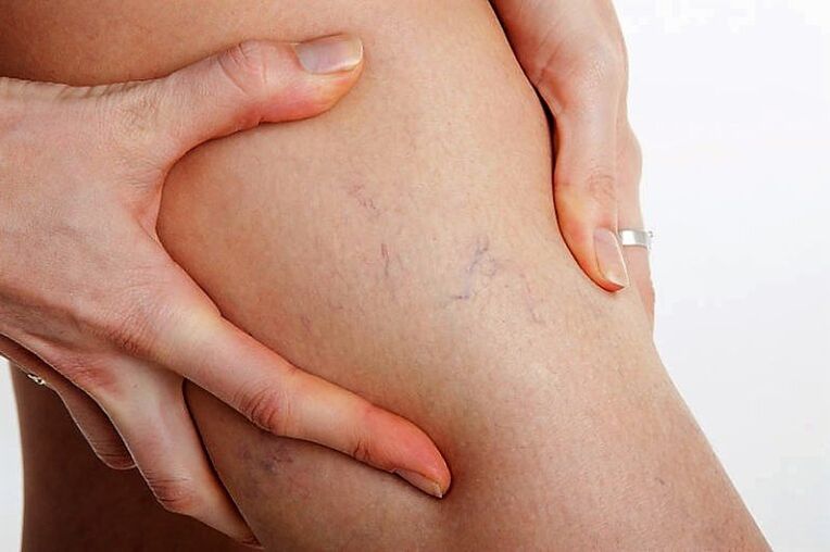 Varicose network in leg