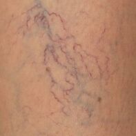 Varicose vein events manifestations