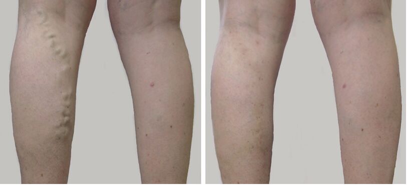 Before and after treatment