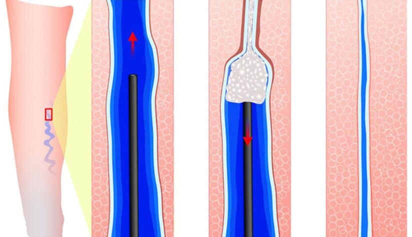 Introduction of sclerosant in sclerotherapy