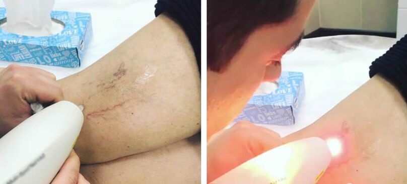 Laser treatment