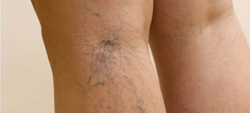 Varicose veins on their feet