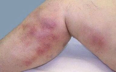 How are varicose veins manifest