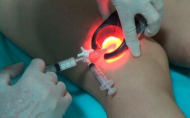sclerotherapy as a way of treating varicose veins on their feet