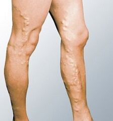 Varicose vein events manifestations