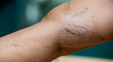 prevention of varicose veins